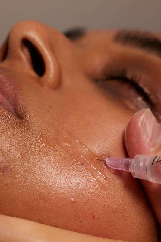 Bio-Stimulators – Sculptra & Radiesse (Collagen & Elastin Inducing Treatments)